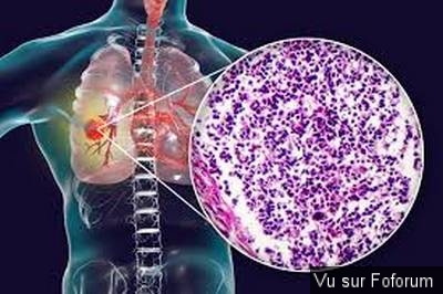 Cancer du poumon, nouvel espoir prometeur.